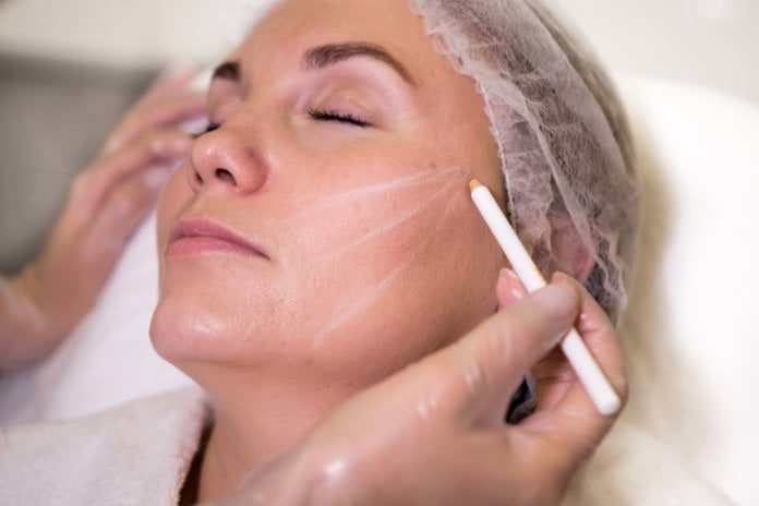 Все о безоперационной подтяжке лица нитями Aptos